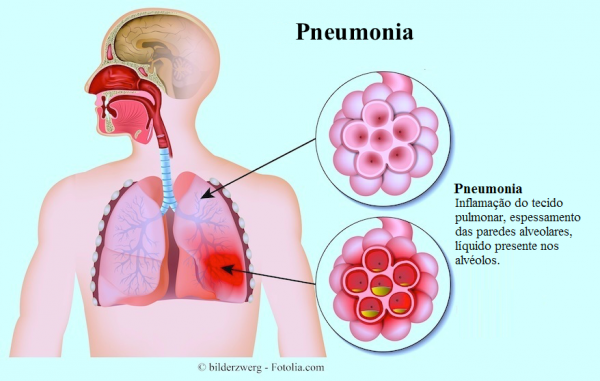 Conheça os tipos de Pneumonia