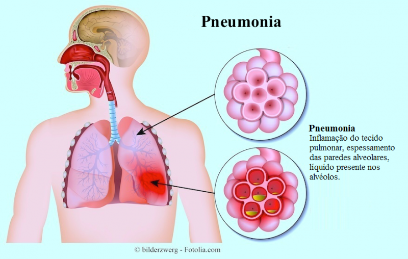 Conheça os tipos de Pneumonia, doença